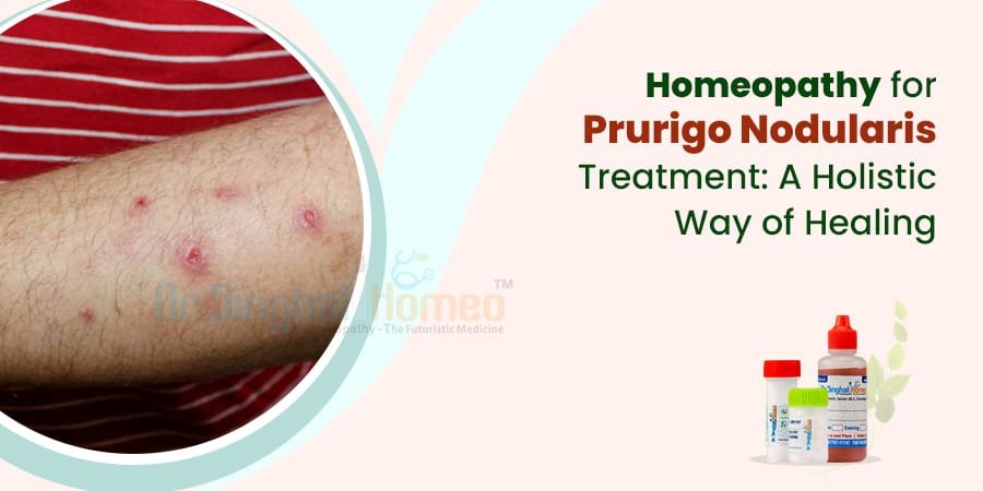 Looking for the Best Doctor for Prurigo Nodularis Treatment? Here’s Why Dr. Vikas Singhal Can Be the Answer!