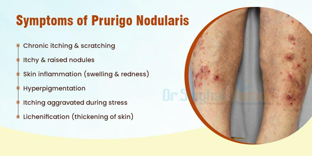 prurigo nodularis homeopathic treatment 